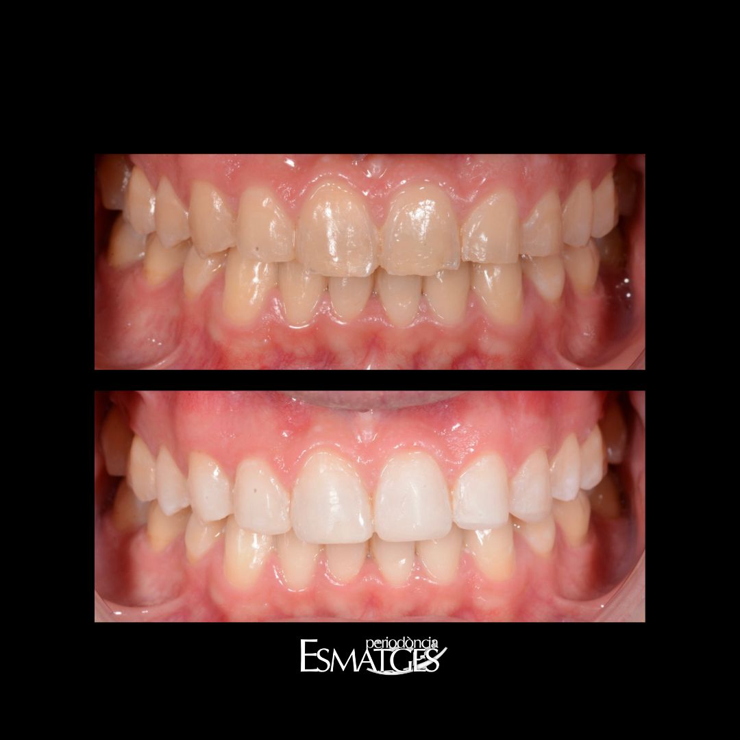 esmatges's tweet photo. #CASOCLÍNICO
CASO 26
BLANQUEAMIENTO DENTAL Y RECONSTRUCCIONES ESTÉTICAS

#Esmatges #clinicadental # #Periodoncia #Genives #Encias #pacientes #Lleida #dentistalleida #odontologo #blanqueamiento #reconstruccionestetica #estetica https://t.co/j9E501E4OY