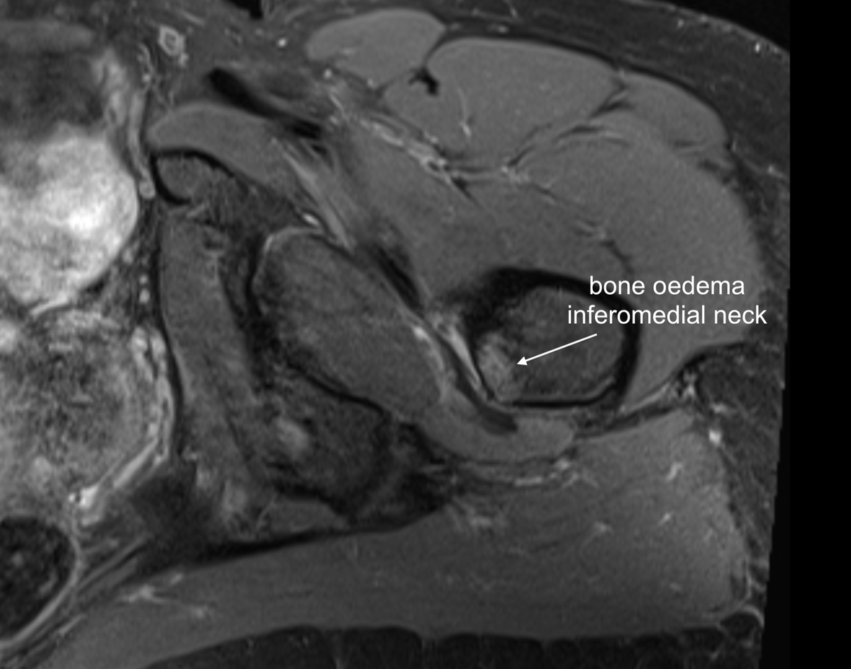 DrJN_SportsMed's tweet photo. MRI results 🤓 - 

inferomedial neck of femur stress response extending towards lesser trochanter - iliopsoas tendon involved (inflammation) at insertion 

See annotated images

Hence pain on hop test & pain / weakness on loading iliopsoas

History key - exam can be misleading re hip flexor

Positive Hop + positive FADIR + asymmetrical weak hip flexor + runner = femoral neck stress # until proven otherwise