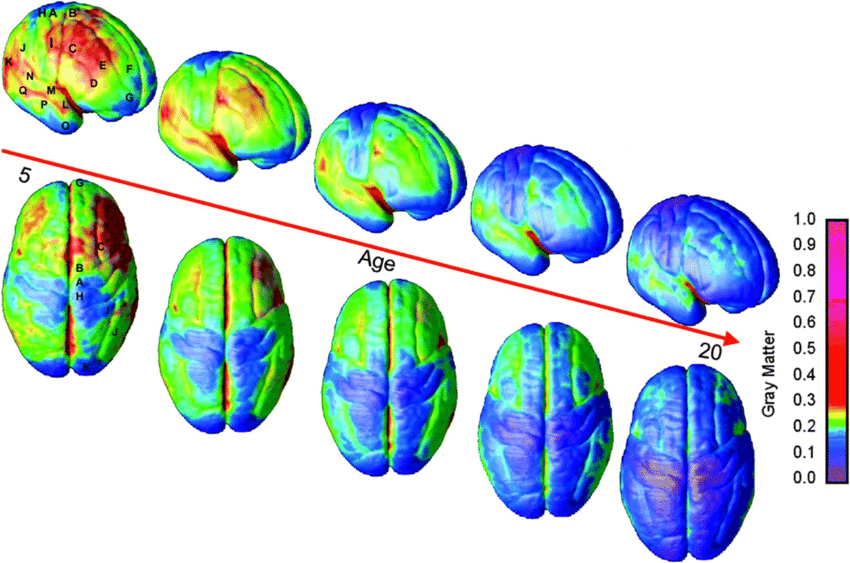lauriewired's tweet photo. One of the most interesting fields in tech revolves around Optimal Brain Damage.

Yes, you heard that right.

First conceptualized by researchers at Bell Labs in 1989, "Optimal Brain Damage" is a way to reduce neural network size.

By selectively deleting weights, they reduced parameters in a handwritten digit recognition network by 75% while slightly improving accuracy.

This mirrors human brain development: infants experience neuronal overgrowth followed by pruning, leading to infantile amnesia.