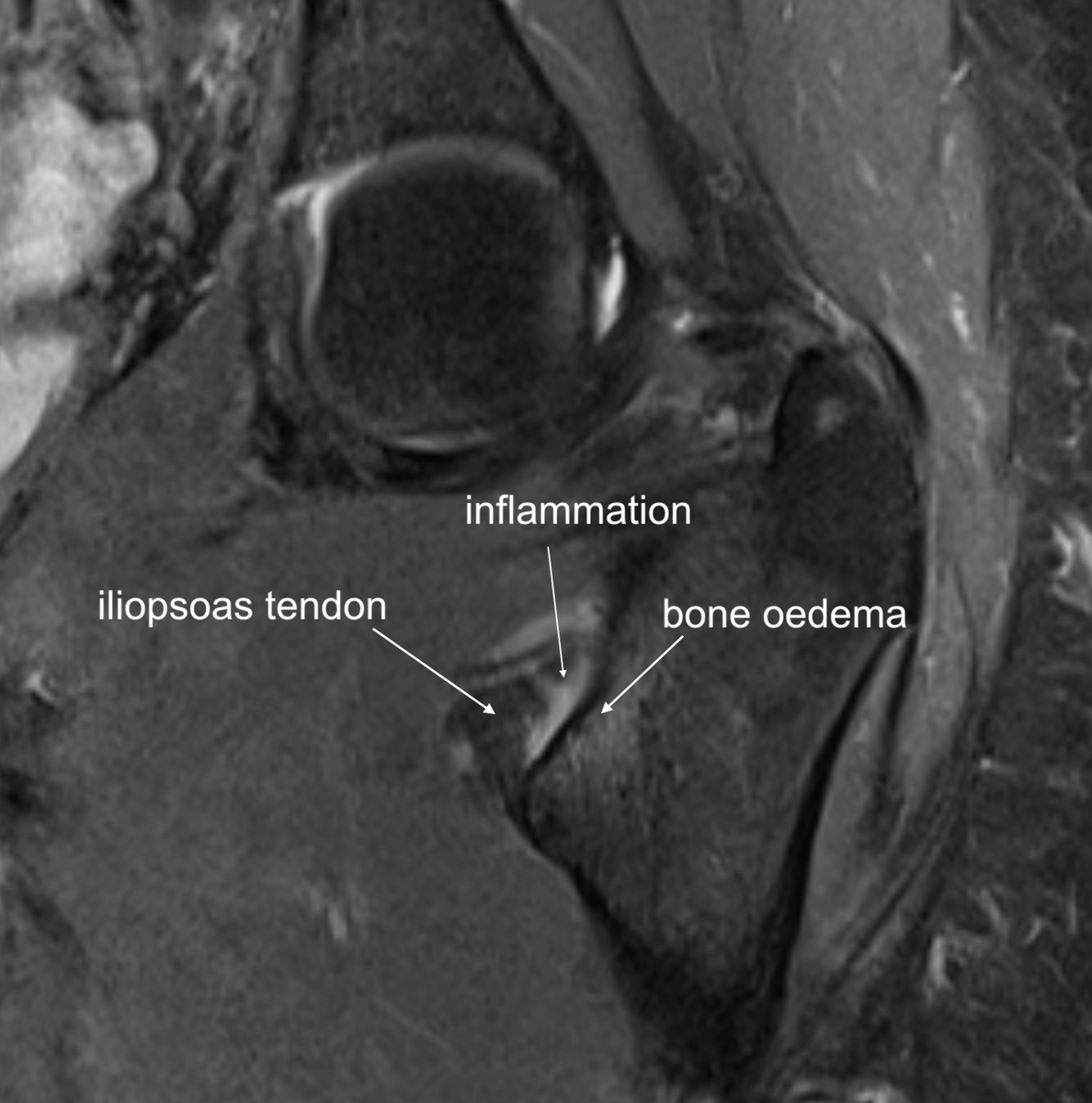DrJN_SportsMed's tweet photo. MRI results 🤓 - 

inferomedial neck of femur stress response extending towards lesser trochanter - iliopsoas tendon involved (inflammation) at insertion 

See annotated images

Hence pain on hop test & pain / weakness on loading iliopsoas

History key - exam can be misleading re hip flexor

Positive Hop + positive FADIR + asymmetrical weak hip flexor + runner = femoral neck stress # until proven otherwise