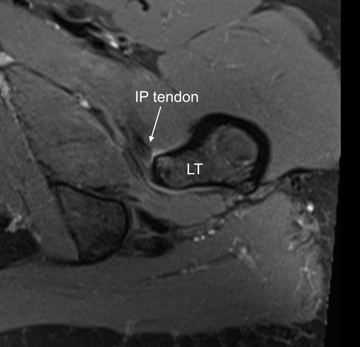 DrJN_SportsMed's tweet photo. MRI results 🤓 - 

inferomedial neck of femur stress response extending towards lesser trochanter - iliopsoas tendon involved (inflammation) at insertion 

See annotated images

Hence pain on hop test & pain / weakness on loading iliopsoas

History key - exam can be misleading re hip flexor

Positive Hop + positive FADIR + asymmetrical weak hip flexor + runner = femoral neck stress # until proven otherwise
