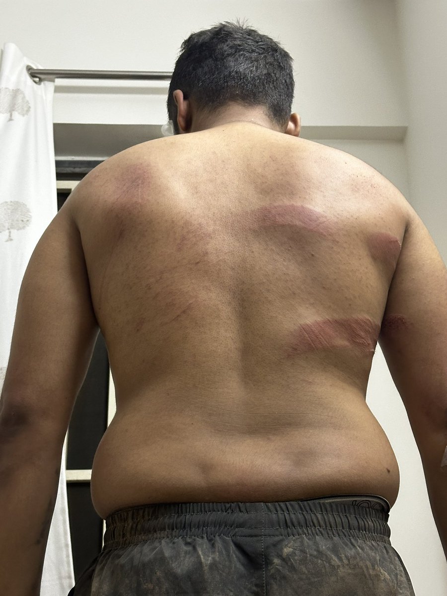 RustagiKashish's tweet photo. URGENT: Seeking Justice for Assault at Arbor Brewing Co. Bangalore
On July 24th, my friend and I were brutally assaulted by bouncers at Arbor Brewing, Ashoka Nagar in Bangalore. We left the club at 12:45AM, complying with the 1 AM closing rule. Due to the rain, we parked our bike https://t.co/pV6STfbltT