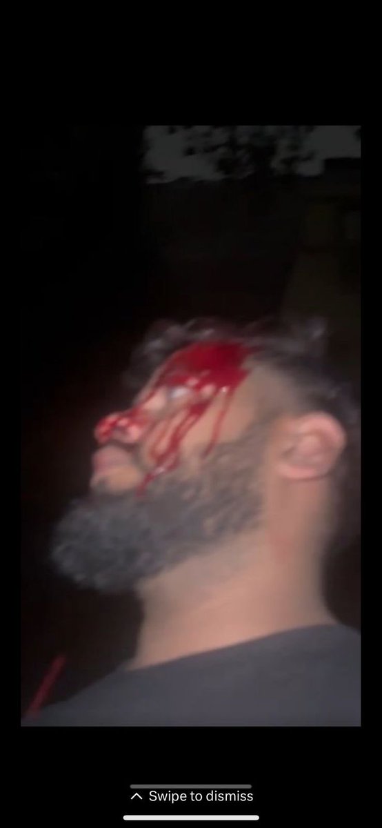 RustagiKashish's tweet photo. URGENT: Seeking Justice for Assault at Arbor Brewing Co. Bangalore
On July 24th, my friend and I were brutally assaulted by bouncers at Arbor Brewing, Ashoka Nagar in Bangalore. We left the club at 12:45AM, complying with the 1 AM closing rule. Due to the rain, we parked our bike https://t.co/pV6STfbltT