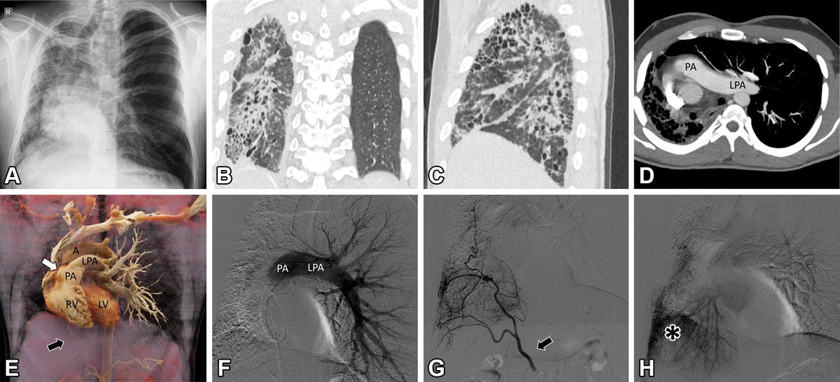 Radiology (@radiology_rsna) on Twitter photo Axial cine chest CT angiography with mediastinal and lung windows shows interruption of the right pulmonary artery at the hilum and systemic collateral vessels from the AP window and celiac trunk. <a href="/lucasdpadua/">Lucas de Pádua, MD PhD</a> bit.ly/3yd2lli Axial cine chest CT angiography with mediastinal and lung windows shows interruption of the right pulmonary artery at the hilum and systemic collateral vessels from the AP window and celiac trunk. <a href="/lucasdpadua/">Lucas de Pádua, MD PhD</a> bit.ly/3yd2lli