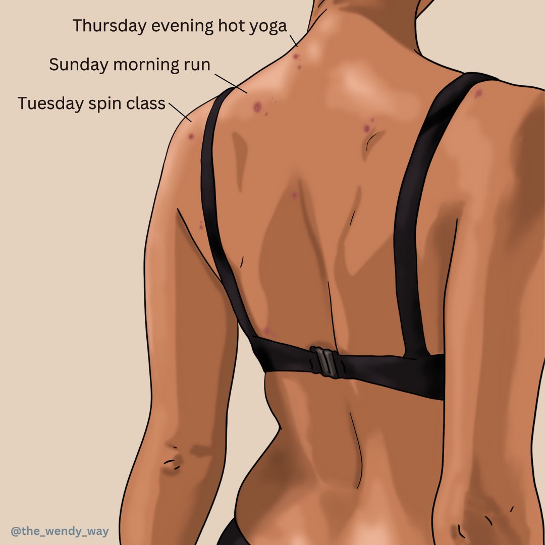 SavingFaceSpa's tweet photo. Ever wonder why certain spots on your back break out? Each blemish tells a story, whether it's from Thursday evening hot yoga, Sunday morning runs, or Tuesday spin classes. From foods to hair care and body wash! 🧘‍♀️🏃‍♀️🚴‍♀️

#thewendyway #bacneispreventable #acneconsultation https://t.co/gEXwbfcWRy