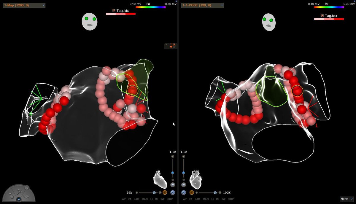 ritmogenesis's tweet photo. Ablación de Fibrilacion auricular persistente con CARTO 3.

Fundamental la utilización del  ICE para guiar punción transeptal dificultosa.

#ICE #AF #ritmogenesis #EPPES https://t.co/MdojUrLMFv