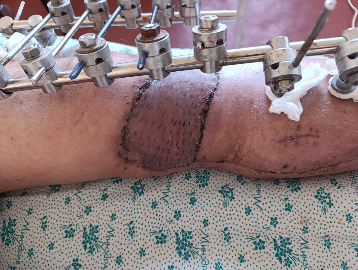 AndrewCmyb's tweet photo. Case#1. Transposition of medial gastrocnemius m. flap gunshot wound and fracture https://t.co/jHVvPRKBq7