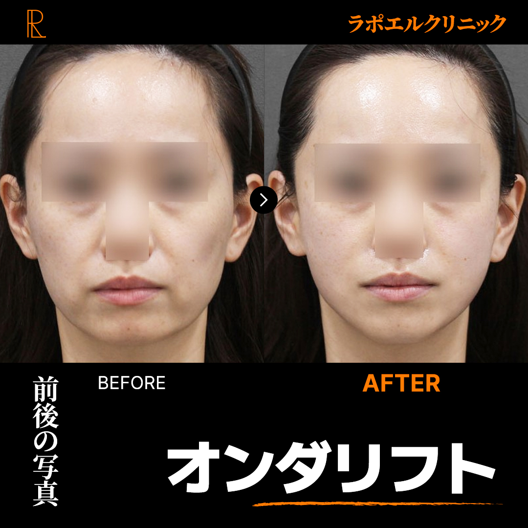 公式】韓国ラポエルクリニック on X: 