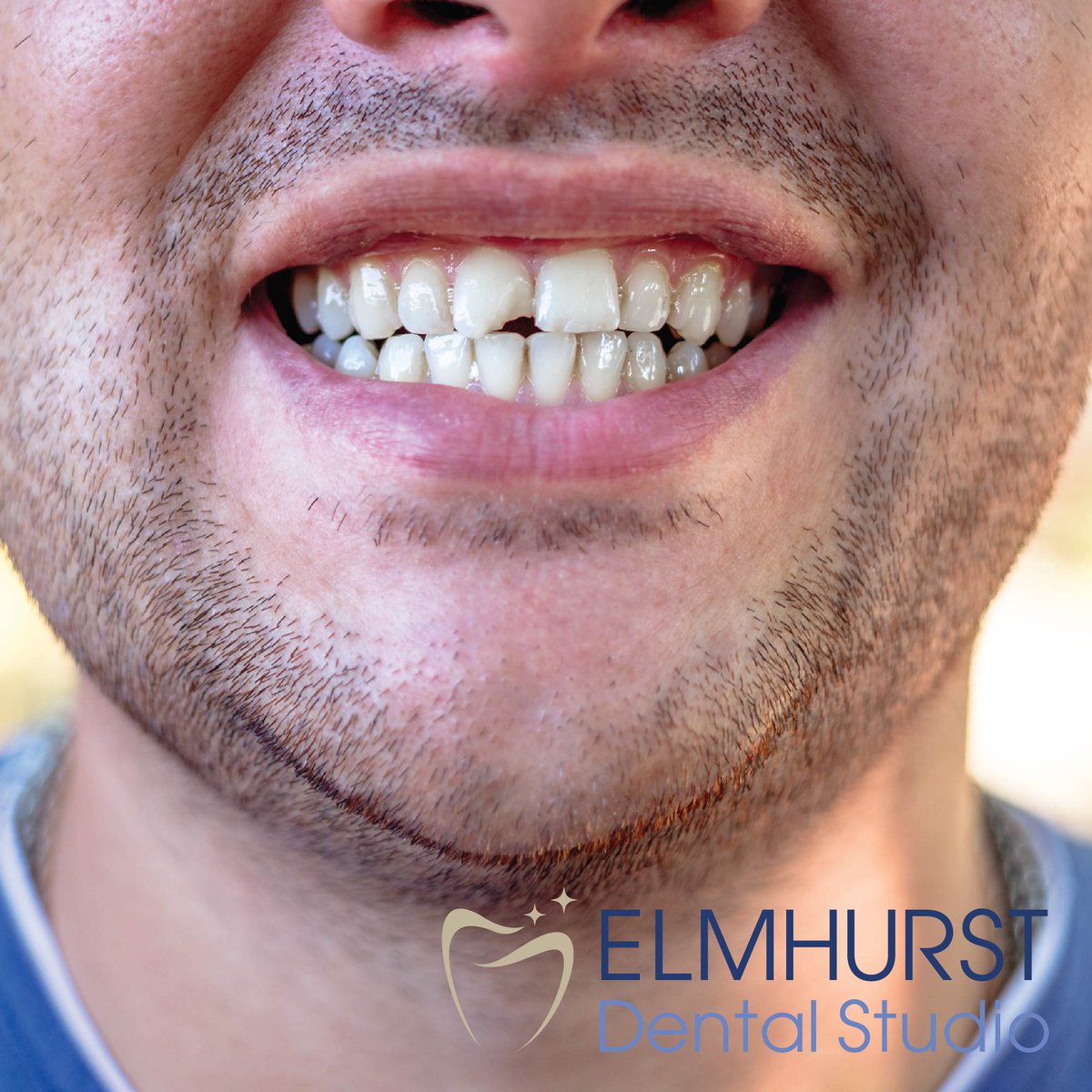 elmhurstdental_'s tweet image. Visit Elmhurst Dental Studio and explore our range of solutions, including fillings, crowns, caps, and dental implants. Your smile's health is our priority!

 (630) 530-0770 
elmhurstdentistil.com
.
.
.
#ChippedTooth #CrackedTooth #ToothReplacement #Crowns #DentalImplants