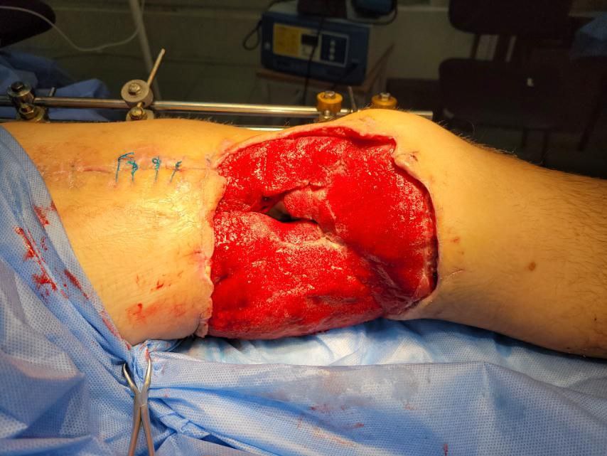AndrewCmyb's tweet photo. Case 4. Gunshot femur fracture with massive soft tissue and bone defects. #trauma #ortho https://t.co/QhnRtSxX0n