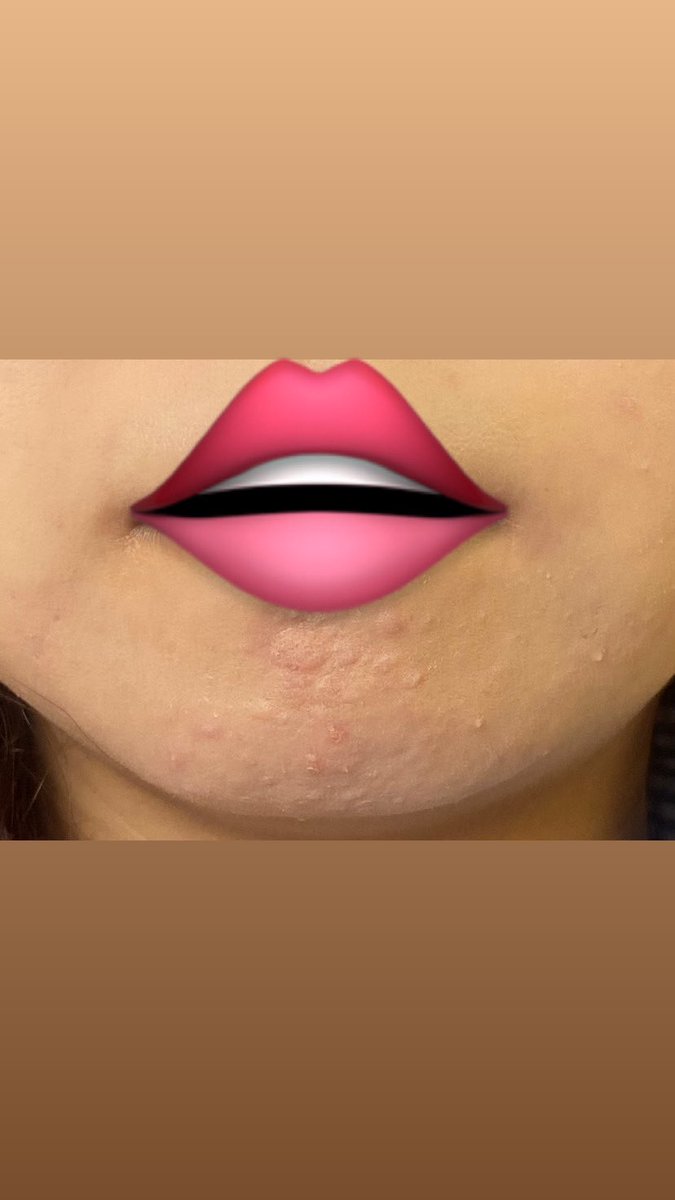 メイク後でも顎ボツボツできも