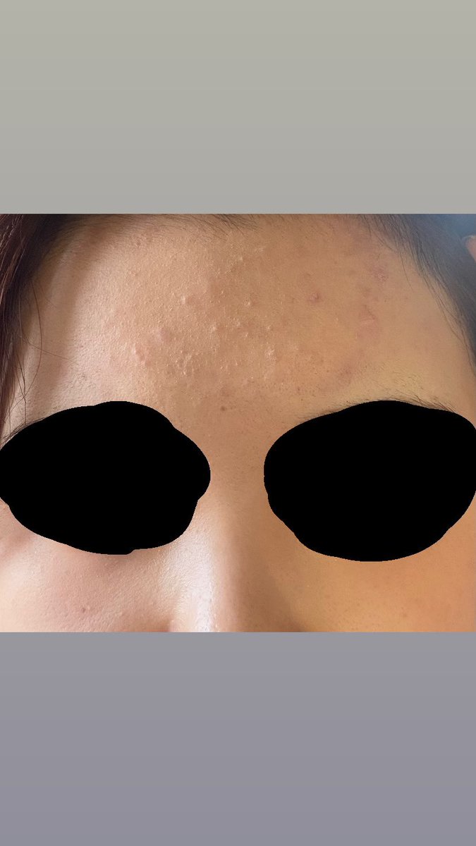 前髪上げた方がニキビできにくいとか言うけど上げててこれだからもうダメだ