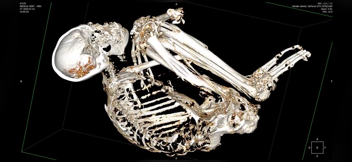 JoseB45355682's tweet photo. Breaking News! 
Tomorrow molecular biologist Dr. Ricardo Rangel will reveal that the latest DNA test results coming out of Canada has found  technosignatures in Maria’s DNA, left by an intelligence almost 2,000 years ago, which makes this Nazca mummy an ancient Artificial hybrid! And when considering that it’s fingerprints are none-human, along with the lack of fossil record in our world of this creature- get us closer to affirm that this creature is of extraterrestrial ancestry!