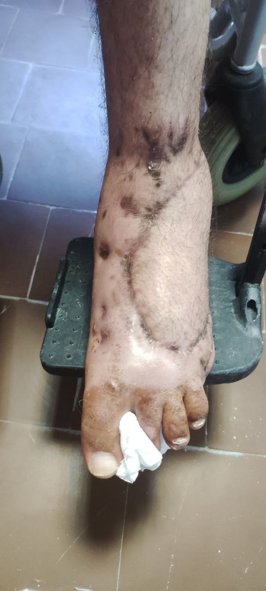 AndrewCmyb's tweet photo. Case 5. Gunshots wouds of ankles. Few fingers amputated. Results https://t.co/BhaPgFcwA0