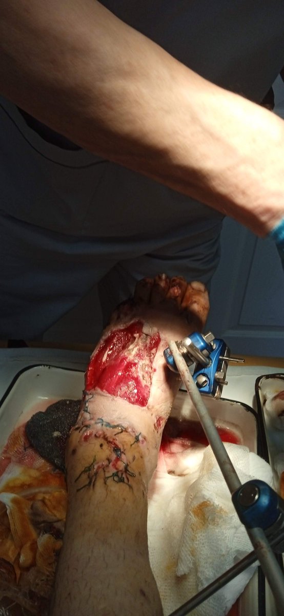 AndrewCmyb's tweet photo. Case 5. Intro. #ortho #trauma https://t.co/TKafcGmqSS