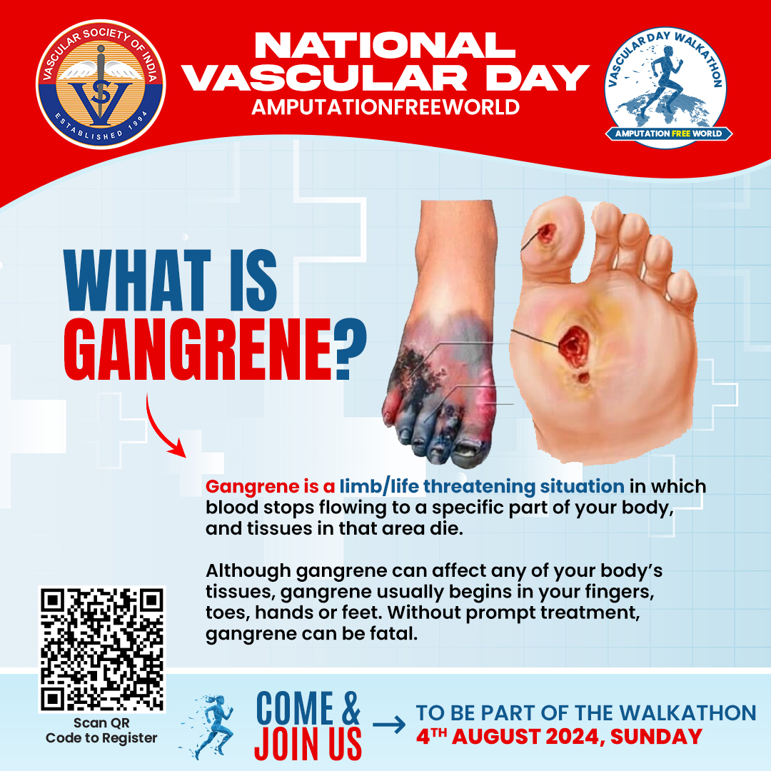 Vascular_India's tweet photo. Let's participate In a Walkathon in 34 cities of India and take a pledge for Amputation free world
𝐍𝐚𝐭𝐢𝐨𝐧𝐚𝐥 𝐕𝐚𝐬𝐜𝐮𝐥𝐚𝐫 𝐃𝐚𝐲
4th August 2024, Sunday
#walkathon #walkathon2024 #vsi #nationalvascularday #amputationfreeworld
@pcvasc https://t.co/RE9NiEweIJ