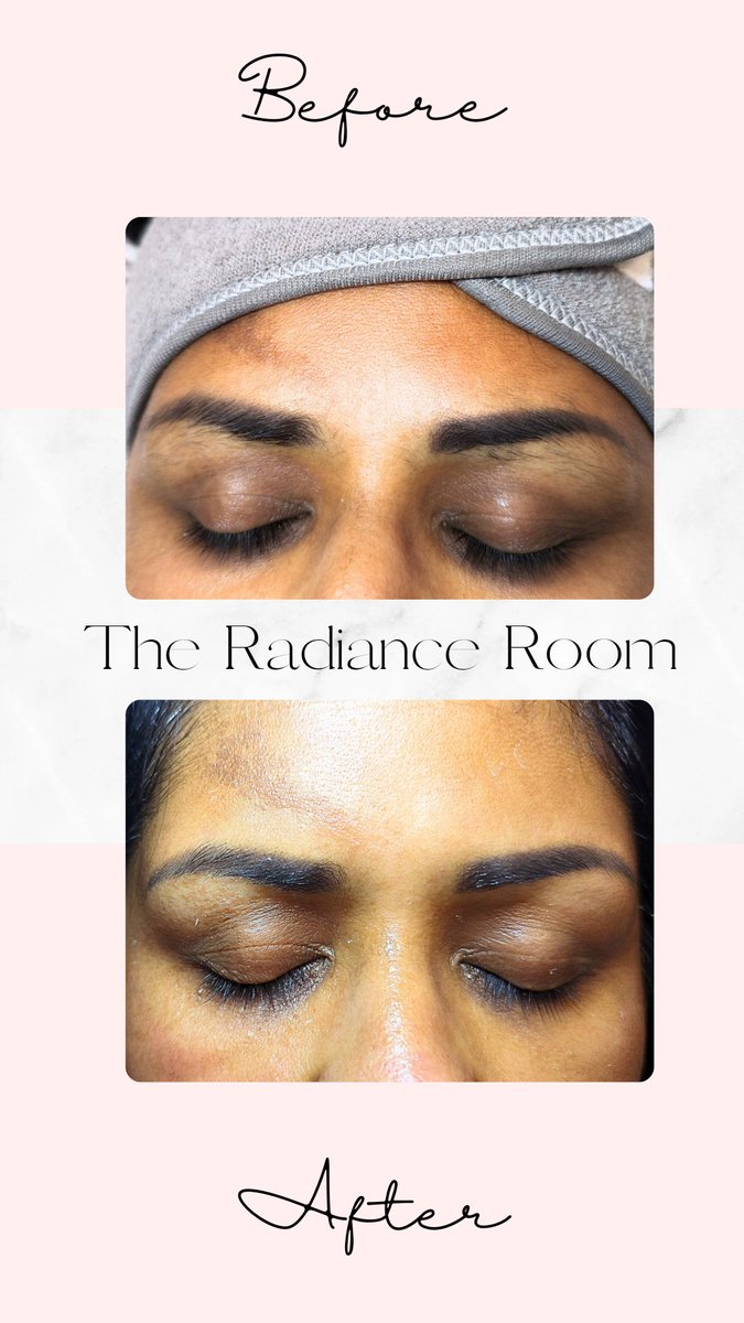 TheRadianceRoom's tweet photo. A simple wax can totally transform the face, exfoliate the skin and boost your confidence 🙌🏼 Book your wax today! 
#waxapplication #hotwaxing #hotwax #beauty #beautytherapy #aloeverawax #smoothskin #hairremoval #waxing #fyp #foryoupage #fy #fypage #beforeandafter #browsonfleek https://t.co/xdbVn0qGWN