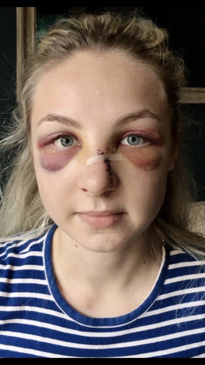 Darren Grey (@dazc46164) on Twitter photo Today in my intentions will be a prayer for this young officers speedy recovery and her wellbeing.
I hope her two colleagues also hospitalised are on the mend too.
Just thought I’d share as <a href="/SkyNews/">Sky News</a> <a href="/BBCNews/">BBC News (UK)</a> <a href="/YvetteCooperMP/">Yvette Cooper</a> and all the rest don’t seem to give a damn Today in my intentions will be a prayer for this young officers speedy recovery and her wellbeing.
I hope her two colleagues also hospitalised are on the mend too.
Just thought I’d share as <a href="/SkyNews/">Sky News</a> <a href="/BBCNews/">BBC News (UK)</a> <a href="/YvetteCooperMP/">Yvette Cooper</a> and all the rest don’t seem to give a damn