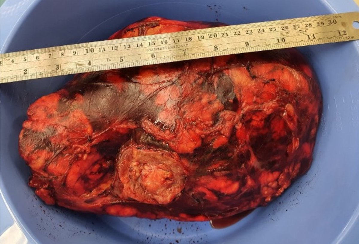 BJU International (@bjuijournal) on Twitter photo August's #CaseOfTheMonth is from the <a href="/PeterMacCC/">Peter Mac Cancer Centre</a>: an operative approach to large renal #angiomyolipoma associated with lymphangioleiomyomatosis <a href="/JonathanSOBrien/">Jonathan O'Brien</a> <a href="/MarcDiocera/">Marc Diocera</a> <a href="/declangmurphy/">Declan Murphy</a> <a href="/lawrentschuk/">Nathan Lawrentschuk</a> <a href="/PetePocharapong/">Pocharapong Jenjitranant</a> <a href="/drMPerera/">marlon perera</a> <a href="/davidgyorki/">David Gyorki</a>
bjui-journals.onlinelibrary.wiley.com/doi/10.1111/bj… August's #CaseOfTheMonth is from the <a href="/PeterMacCC/">Peter Mac Cancer Centre</a>: an operative approach to large renal #angiomyolipoma associated with lymphangioleiomyomatosis <a href="/JonathanSOBrien/">Jonathan O'Brien</a> <a href="/MarcDiocera/">Marc Diocera</a> <a href="/declangmurphy/">Declan Murphy</a> <a href="/lawrentschuk/">Nathan Lawrentschuk</a> <a href="/PetePocharapong/">Pocharapong Jenjitranant</a> <a href="/drMPerera/">marlon perera</a> <a href="/davidgyorki/">David Gyorki</a>
bjui-journals.onlinelibrary.wiley.com/doi/10.1111/bj…