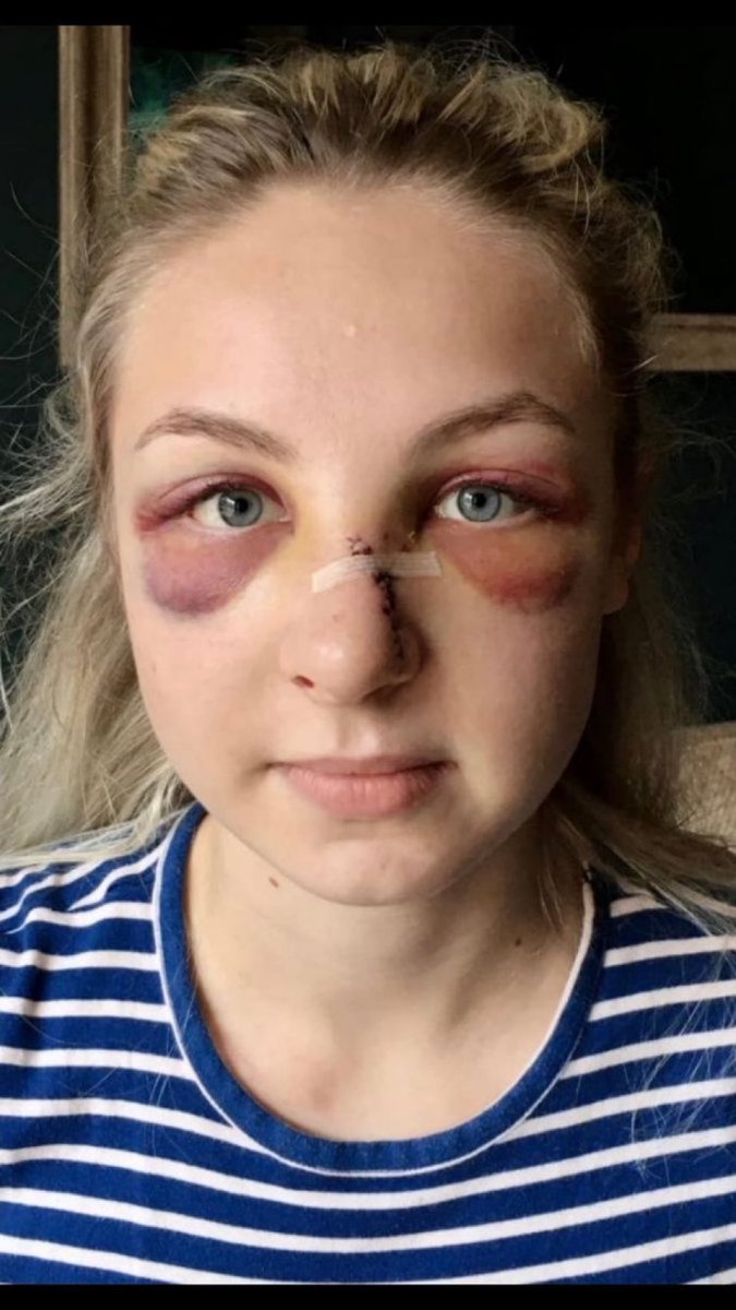 pswhitmore's tweet image. Does anyone know who this is?
Probably not, although these injuries also occurred at Manchester airport. It’s because her image and story has not gone viral, due to the outrage and demonstrations from similar looking communities.
Let’s change the narrative - please share