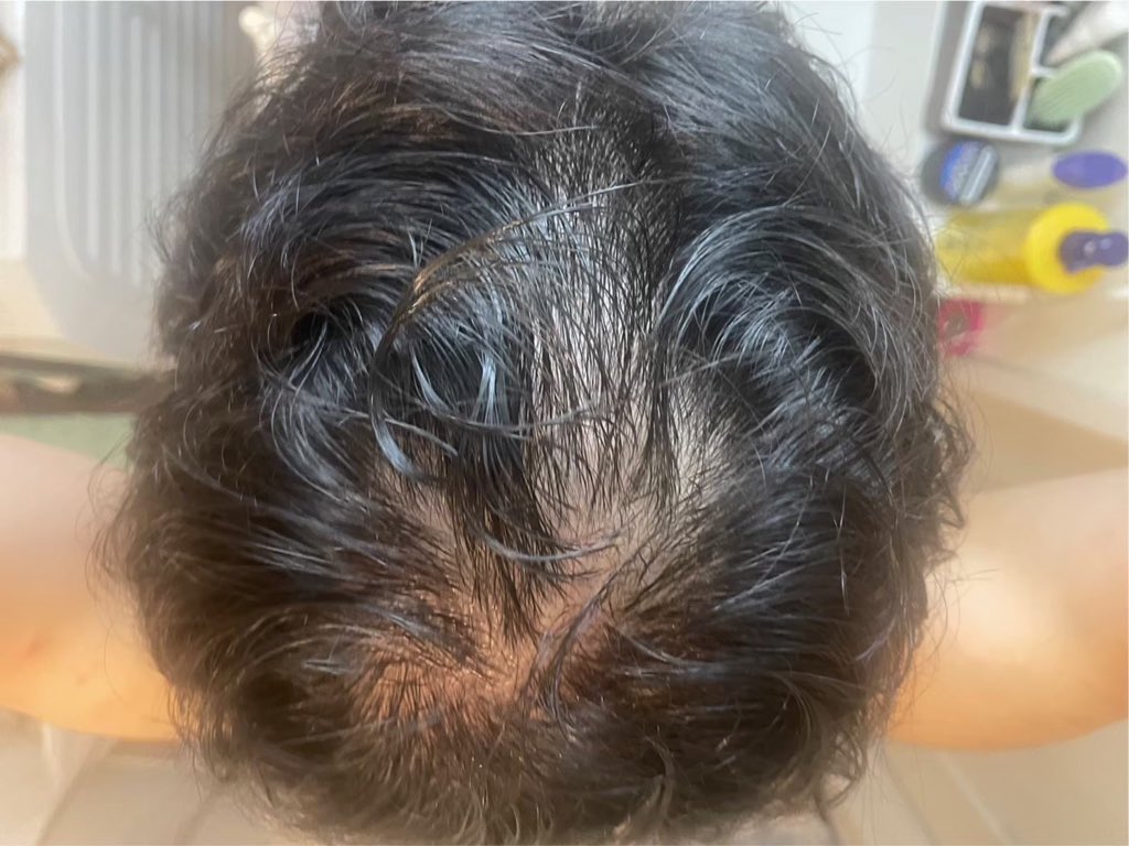 コウ@AGA治療で薄毛改善 tweet media