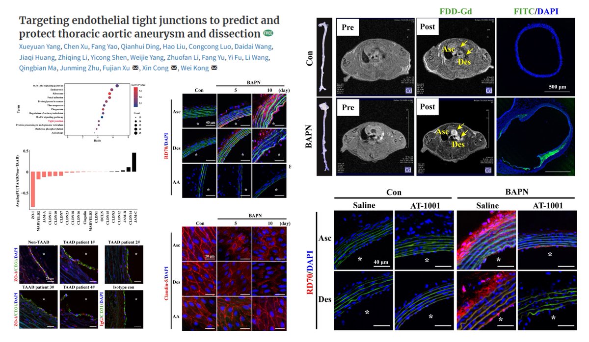 HaoYin20's tweet photo. #EndothalialCell #TightJunction #AorticDissection
In👤#ThoracicAorticDissection, tight junctions loosen (Multi-Transcripts⏬)
In🐭BAPN1⃣Thoracic aortic endothelial permeability⏫at day 5, before any macroscopic dissection
2⃣Aortic VE-cadherin junctions remain unaltered
3⃣AT-1001, a PAR2 inhibitor, reseals ZO-1 TJ, ⏬aortic permeability (70 kD), ⏬incidence of dissection by >50%
4⃣EC ZO-1 KO⏫dissection🤓
#AortaEd
#EHJ 2023 @ESC_Journals
https://t.co/5x30ruc0hT