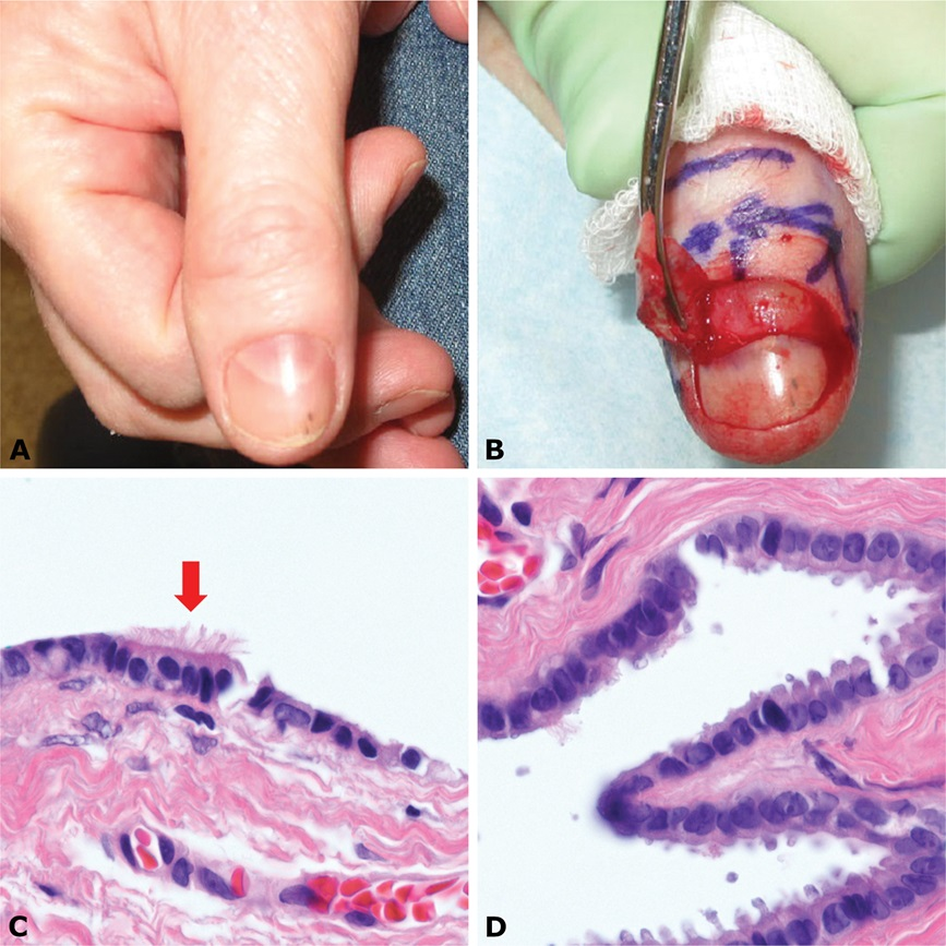 #ClinicalPathologicChallenge

<a href="/Hansalah/">Haneen Salah</a> <a href="/JDuranMD/">Juanita Duran, MD</a> <a href="/alegru18/">Alejandro Gru (Ale)</a> share an interesting case of a 55F with a 1-year history of 7 × 4-mm erythematous-to-violaceous, nontender subungual mass overlying the lunula of the right thumb
 <a href="/MethodistHosp/">Houston Methodist</a> <a href="/UVA_Pathology/">UVA Pathology</a> <a href="/Columbia/">Columbia University</a> <a href="/ColumbiaMed/">Columbia Medicine</a> 
Dx?