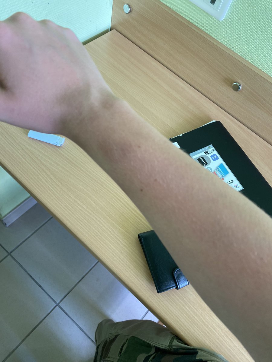Gby2203's tweet photo. Résultat de la bagarre au charbon d’hier 😂😂😂😂 me suis peut-être un peu trop débattu https://t.co/2IPJ7mKVZx