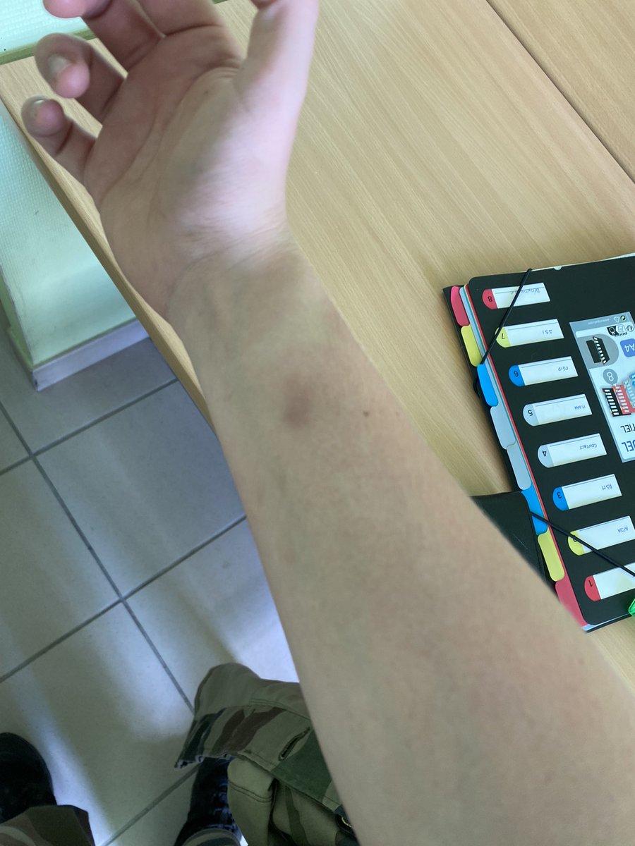Gby2203's tweet photo. Résultat de la bagarre au charbon d’hier 😂😂😂😂 me suis peut-être un peu trop débattu https://t.co/2IPJ7mKVZx