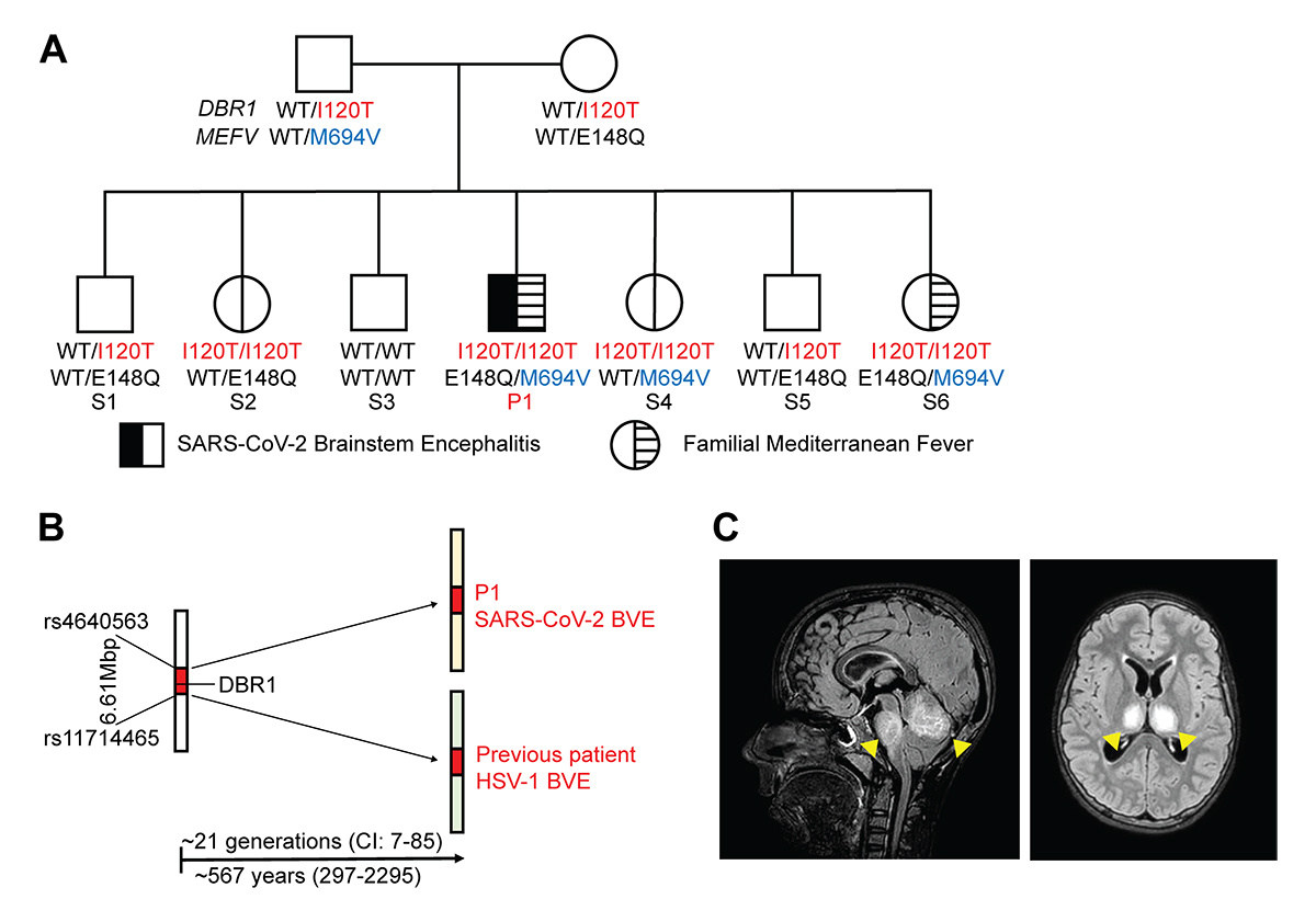 Journal of Experimental Medicine (@jexpmed) on Twitter photo #SARSCoV2 brainstem encephalitis in human inherited DBR1 deficiency. New study from Yi-Hao Chan (<a href="/yihaoo/">Yi-Hao Chan Lab</a>), Vanja Lundberg, Jérémie Le Pen, Jiayi Yuan, @harschnitz, <a href="/RiceLaboratory/">Rice Lab</a>, <a href="/studerl/">Lorenz</a>, <a href="/casanova_lab/">Casanova Lab</a>, Olov Ekwall, <a href="/ShenYingZhang1/">Shen-Ying Zhang</a> and colleagues: hubs.la/Q02Hh90t0 #SARSCoV2 brainstem encephalitis in human inherited DBR1 deficiency. New study from Yi-Hao Chan (<a href="/yihaoo/">Yi-Hao Chan Lab</a>), Vanja Lundberg, Jérémie Le Pen, Jiayi Yuan, @harschnitz, <a href="/RiceLaboratory/">Rice Lab</a>, <a href="/studerl/">Lorenz</a>, <a href="/casanova_lab/">Casanova Lab</a>, Olov Ekwall, <a href="/ShenYingZhang1/">Shen-Ying Zhang</a> and colleagues: hubs.la/Q02Hh90t0