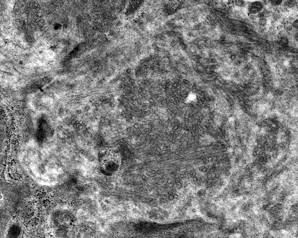 Jonathan Zuckerman MD PhD (@jzrenalpath) on Twitter photo Always satisfying to find well developed organizing deposits by EM. This is a case of immunotactoid glomerulopathy. Microtubules in parallel arrays in, >30 nm in diameter. #renalpath #pathtwitter #nephrology Always satisfying to find well developed organizing deposits by EM. This is a case of immunotactoid glomerulopathy. Microtubules in parallel arrays in, >30 nm in diameter. #renalpath #pathtwitter #nephrology
