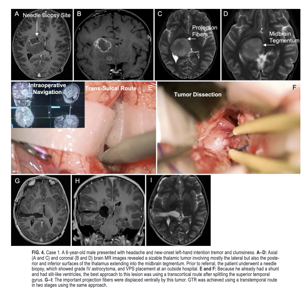 #OnlineFirst: Microsurgical anatomy and approaches to thalamic gliomas. Part 2: Maximal safe resection of thalamic gliomas improves outcomes. A single-center experience. 

thejns.org/view/journals/….