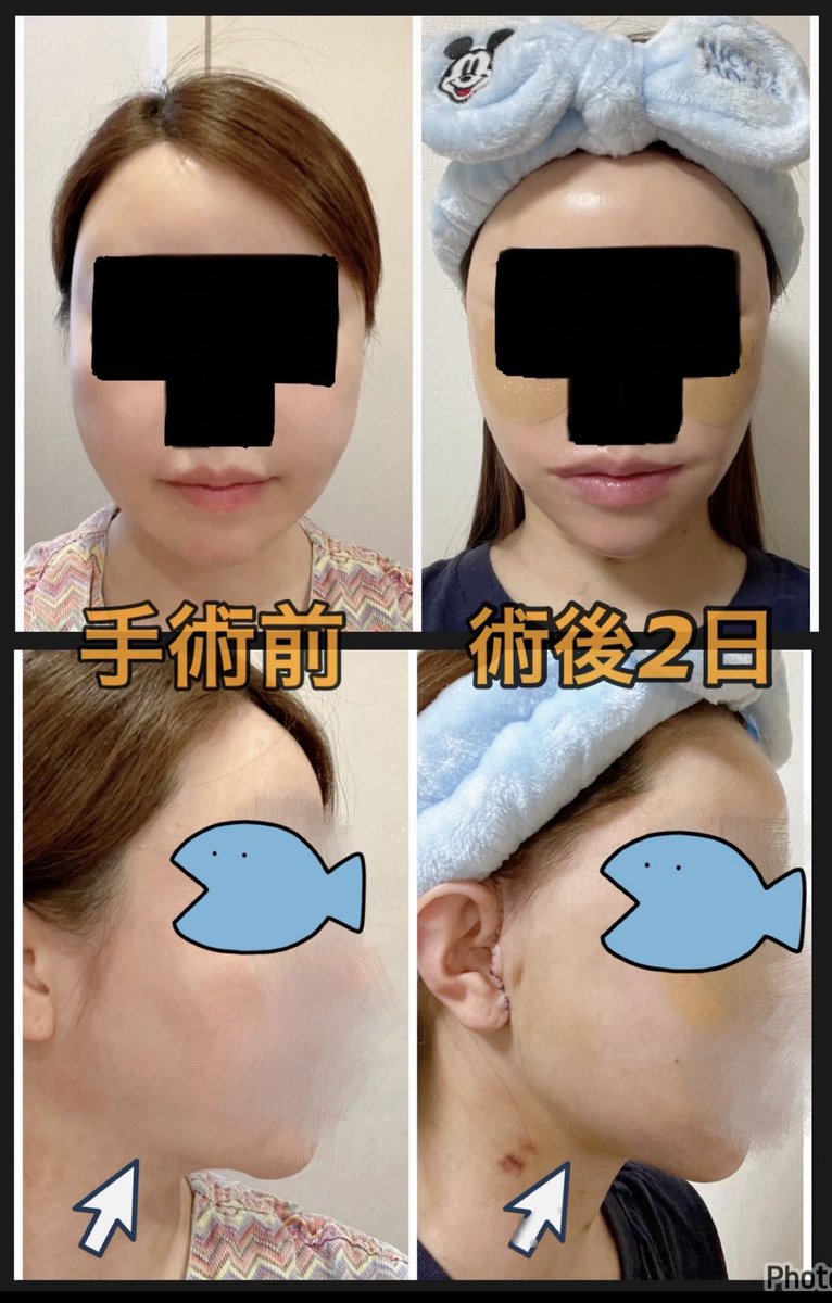 タシピウムで切開リフトしました☺️✂️
これはもうやって良かった整形ベスト3に入る！！両顎と輪郭再手術してだるだるに弛んだ顔を見るたびに病んでたけど弛みが無くなって一気に若返った😭8病院カウセ回ったけどタシピウムを選んで本当に大正解。これから詳しくレポしていきます🙋‍♀️⬇️ https://t.co/DTy2dBqCb8