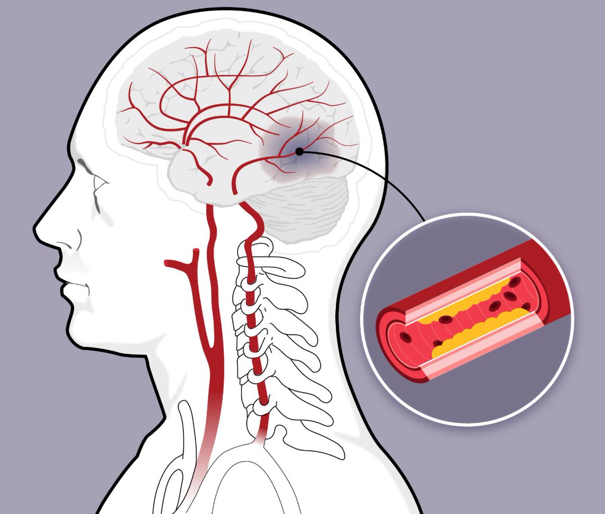 MesharyAlali's tweet image. في الآونة الاخيرة نرى جلطات دماغية باعمار صغيرة لم تكن مشاهدة من قبل
هنا ثريد نبين فيه :
-ماهي الجلطات الدماغية؟
-ماهي اعراضها ؟
-متى تزور الطبيب؟
-ماهي اسبابها؟
-ماهي عوامل الاختطار؟
-كيفية تجنبها(الوقاية).
-طرق ووسائل العلاج.