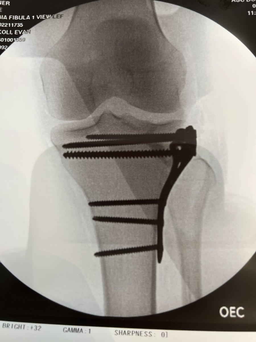 A @movebettersam story:

My wife, a trail runner, broke her leg skiing 16 months ago. Even with hours of PT a week, her recovery plateaued last August.

Running 5 miles was near impossible. She was worried she’d never fully recover.