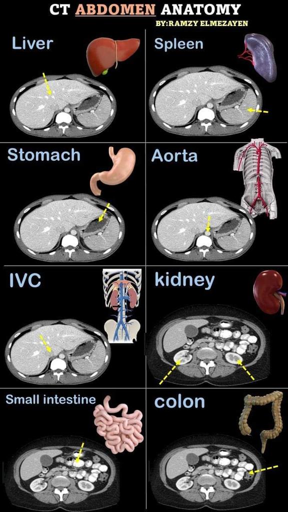 Dr_Abdualbaset's tweet photo. CT Abdomen anatomy ✌️
من فضلك متابعة👍 اعجاب ورتويت💙 https://t.co/fQaKdtuQeA