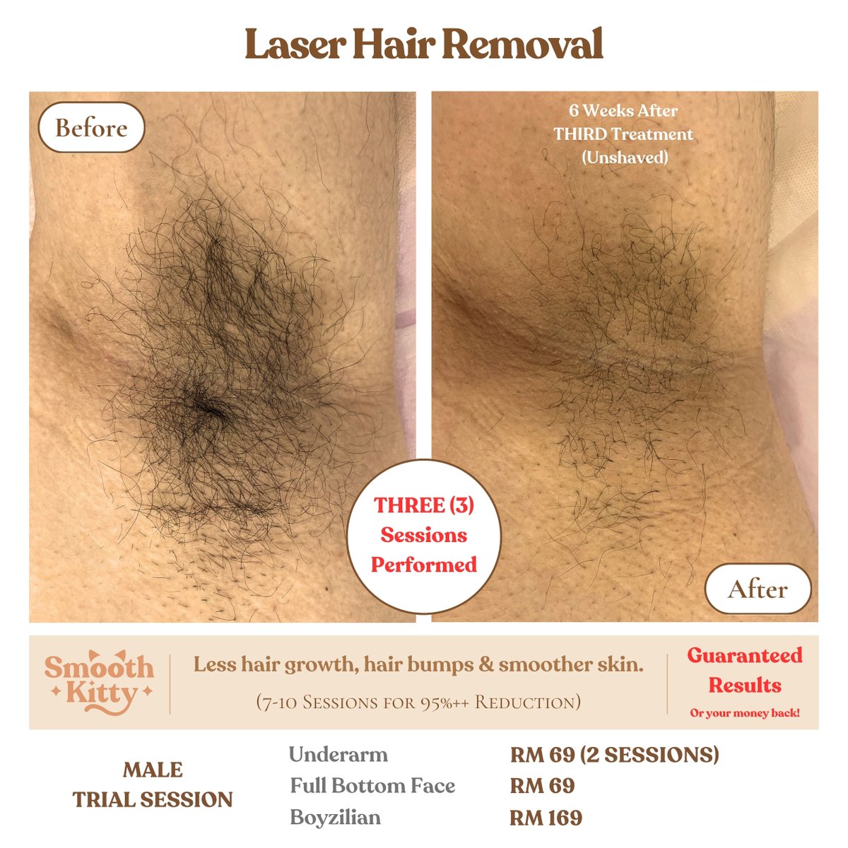 SmoothKittyMY's tweet photo. 🔥GUARANTEED RESULTS 🔥

🌟 Laser Hair Removal🌟

Tired of the constant battle with razors, waxing, and endless plucking?

Experience the ultimate transformation with our Laser Hair Removal services, powered by the state-of-the-art Soprano Titanium laser!

✨ Our clients' results speak for themselves. Just look at these stunning before-and-after photos! ✨

Why Choose Our Soprano Titanium Laser Hair Removal:
✅ Permanent hair reduction
✅ Suitable for ALL skin types.
✅ FDA certified for safety and effectiveness
✅ Virtually painless and quick
✅ Say goodbye to ingrown hairs

💰 We're so confident in our Soprano Titanium laser's ability to deliver results that we offer a MONEY-BACK GUARANTEE if you don't see the transformation you desire.

Check out our 100's of reviews.

https://t.co/liWfSwI8O9