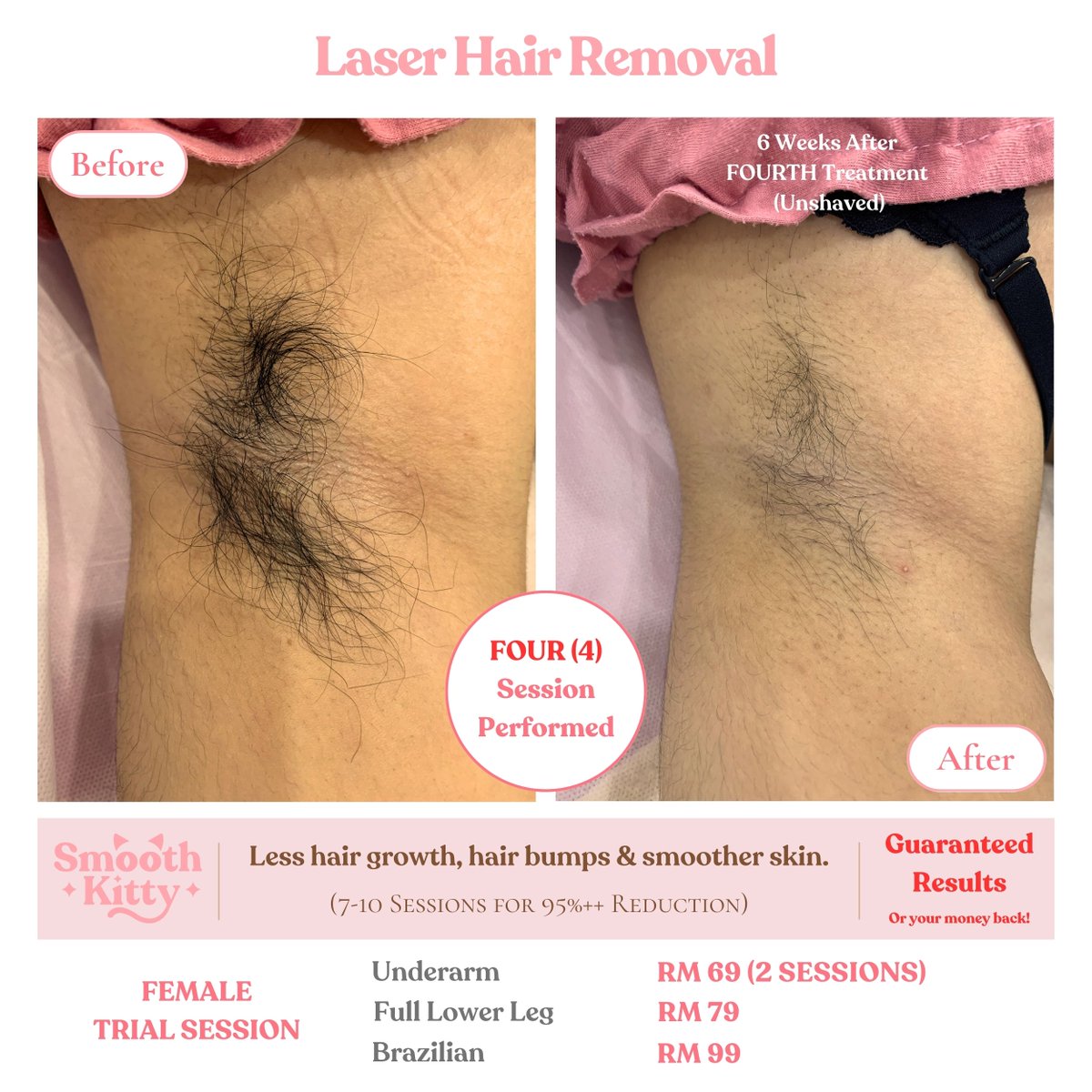 SmoothKittyMY's tweet photo. 🔥GUARANTEED RESULTS 🔥

🌟 Laser Hair Removal🌟

Tired of the constant battle with razors, waxing, and endless plucking?

Experience the ultimate transformation with our Laser Hair Removal services, powered by the state-of-the-art Soprano Titanium laser!

✨ Our clients' results speak for themselves. Just look at these stunning before-and-after photos! ✨

Why Choose Our Soprano Titanium Laser Hair Removal:
✅ Permanent hair reduction
✅ Suitable for ALL skin types.
✅ FDA certified for safety and effectiveness
✅ Virtually painless and quick
✅ Say goodbye to ingrown hairs

💰 We're so confident in our Soprano Titanium laser's ability to deliver results that we offer a MONEY-BACK GUARANTEE if you don't see the transformation you desire.

Check out our 100's of reviews.

https://t.co/liWfSwI8O9