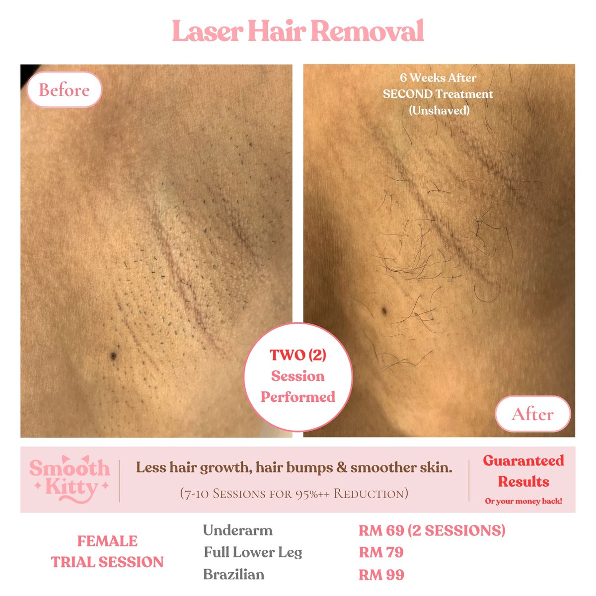 SmoothKittyMY's tweet photo. 🔥GUARANTEED RESULTS 🔥

🌟 Laser Hair Removal🌟

Tired of the constant battle with razors, waxing, and endless plucking?

Experience the ultimate transformation with our Laser Hair Removal services, powered by the state-of-the-art Soprano Titanium laser!

✨ Our clients' results speak for themselves. Just look at these stunning before-and-after photos! ✨

Why Choose Our Soprano Titanium Laser Hair Removal:
✅ Permanent hair reduction
✅ Suitable for ALL skin types.
✅ FDA certified for safety and effectiveness
✅ Virtually painless and quick
✅ Say goodbye to ingrown hairs

💰 We're so confident in our Soprano Titanium laser's ability to deliver results that we offer a MONEY-BACK GUARANTEE if you don't see the transformation you desire.

Check out our 100's of reviews.

https://t.co/liWfSwI8O9