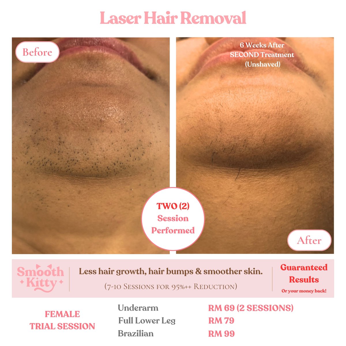 SmoothKittyMY's tweet photo. 🔥GUARANTEED RESULTS 🔥

🌟 Laser Hair Removal🌟

Tired of the constant battle with razors, waxing, and endless plucking?

Experience the ultimate transformation with our Laser Hair Removal services, powered by the state-of-the-art Soprano Titanium laser!

✨ Our clients' results speak for themselves. Just look at these stunning before-and-after photos! ✨

Why Choose Our Soprano Titanium Laser Hair Removal:
✅ Permanent hair reduction
✅ Suitable for ALL skin types.
✅ FDA certified for safety and effectiveness
✅ Virtually painless and quick
✅ Say goodbye to ingrown hairs

💰 We're so confident in our Soprano Titanium laser's ability to deliver results that we offer a MONEY-BACK GUARANTEE if you don't see the transformation you desire.

Check out our 100's of reviews.

https://t.co/liWfSwI8O9