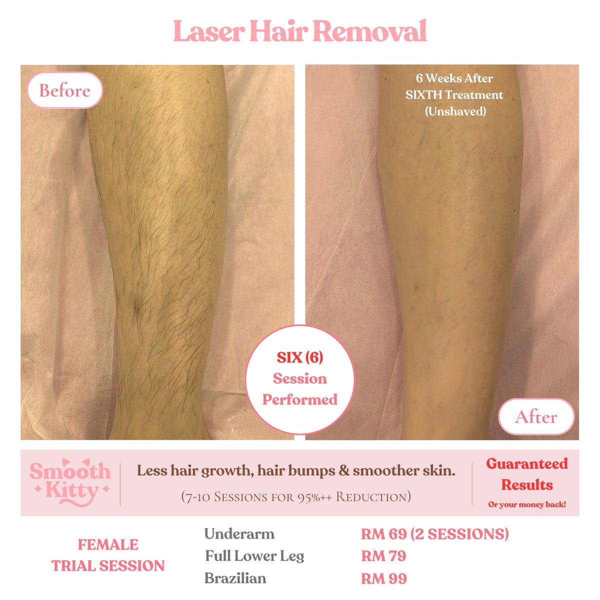 SmoothKittyMY's tweet photo. 🔥GUARANTEED RESULTS 🔥

🌟 Laser Hair Removal🌟

Tired of the constant battle with razors, waxing, and endless plucking?

Experience the ultimate transformation with our Laser Hair Removal services, powered by the state-of-the-art Soprano Titanium laser!

✨ Our clients' results speak for themselves. Just look at these stunning before-and-after photos! ✨

Why Choose Our Soprano Titanium Laser Hair Removal:
✅ Permanent hair reduction
✅ Suitable for ALL skin types.
✅ FDA certified for safety and effectiveness
✅ Virtually painless and quick
✅ Say goodbye to ingrown hairs

💰 We're so confident in our Soprano Titanium laser's ability to deliver results that we offer a MONEY-BACK GUARANTEE if you don't see the transformation you desire.

Check out our 100's of reviews.

https://t.co/liWfSwI8O9