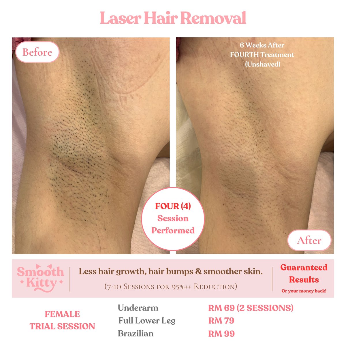 SmoothKittyMY's tweet photo. 🔥GUARANTEED RESULTS 🔥

🌟 Laser Hair Removal🌟

Tired of the constant battle with razors, waxing, and endless plucking?

Experience the ultimate transformation with our Laser Hair Removal services, powered by the state-of-the-art Soprano Titanium laser!

✨ Our clients' results speak for themselves. Just look at these stunning before-and-after photos! ✨

Why Choose Our Soprano Titanium Laser Hair Removal:
✅ Permanent hair reduction
✅ Suitable for ALL skin types.
✅ FDA certified for safety and effectiveness
✅ Virtually painless and quick
✅ Say goodbye to ingrown hairs

💰 We're so confident in our Soprano Titanium laser's ability to deliver results that we offer a MONEY-BACK GUARANTEE if you don't see the transformation you desire.

Check out our 100's of reviews.

https://t.co/liWfSwI8O9