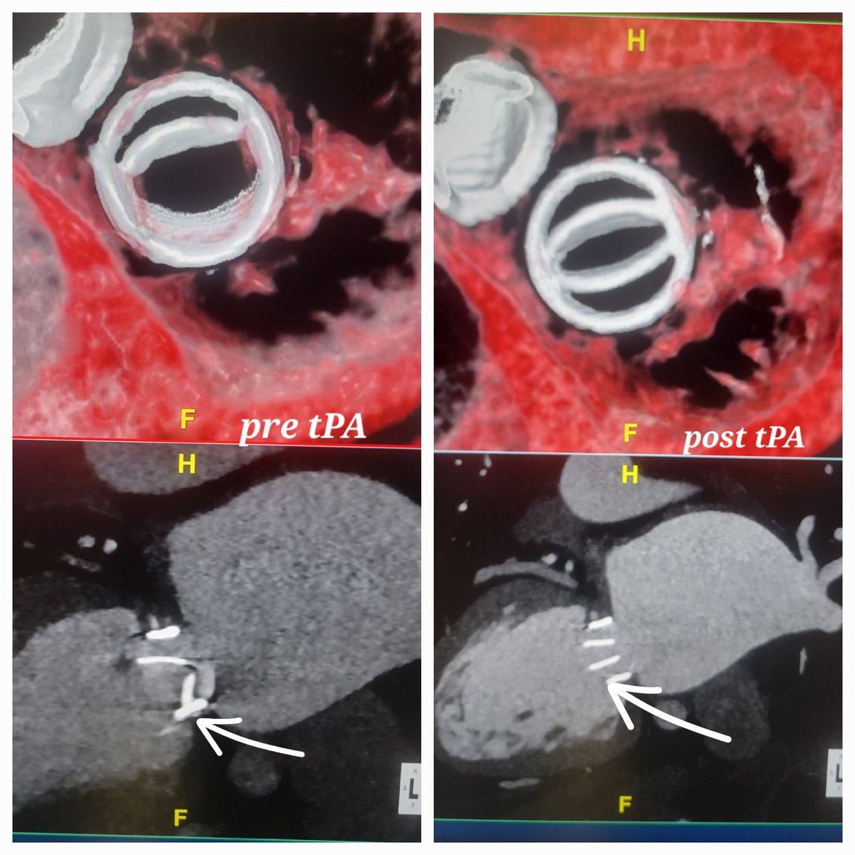 AmroAlsaid's tweet image. Hard not to love #yesCCT! Mechanical mitral valve assessment  pre and post tPA in pt with very challanging #echofirst images. #CVimaging @Kfarooqi @rooshaparikh @OKhaliqueMD @purviparwani @onco_cardiology @tiffchenMD @Steph_Achenbach @Doc_Tiger @Heart_SCCT @HeartPlano