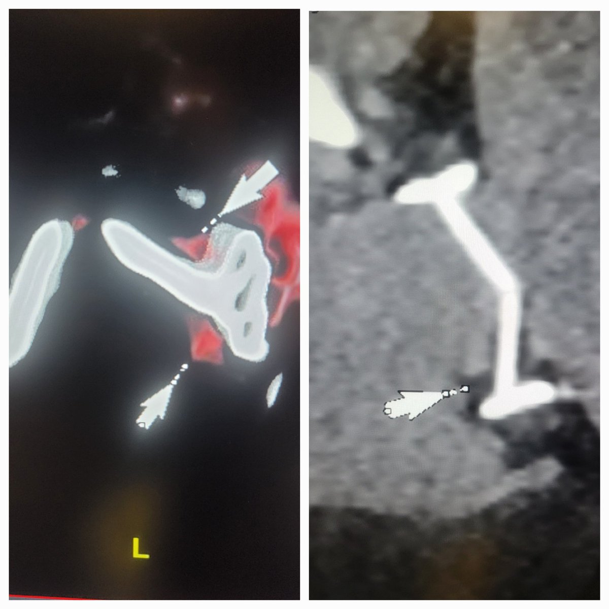 AmroAlsaid's tweet image. Hard not to love #yesCCT! Mechanical mitral valve assessment  pre and post tPA in pt with very challanging #echofirst images. #CVimaging @Kfarooqi @rooshaparikh @OKhaliqueMD @purviparwani @onco_cardiology @tiffchenMD @Steph_Achenbach @Doc_Tiger @Heart_SCCT @HeartPlano