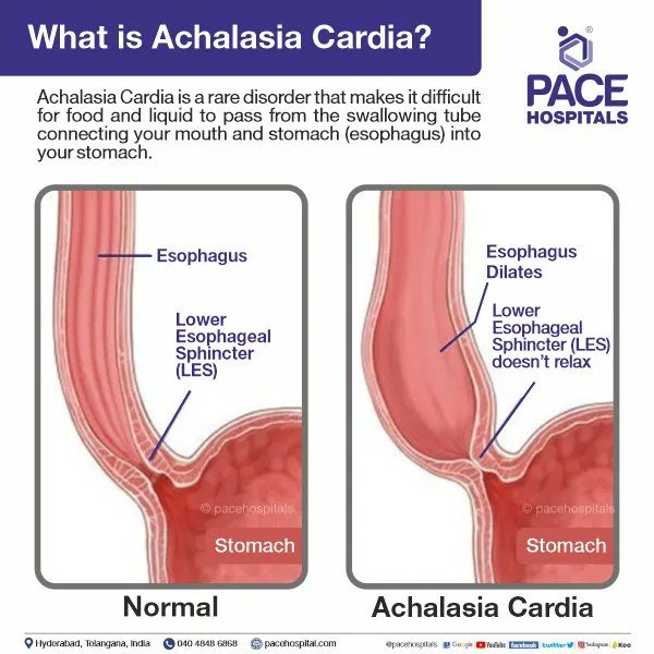 AB_drmd's tweet photo. ما هي Achalasia؟
هو اضطراب نادر في حركة المريء يتميز بعدم قدرة lower esophageal sphincter (LES) على الاسترخاء و غياب normal esophageal peristalsis. يؤدي هذا إلى صعوبة في البلع (عسر البلع)، ارتجاع الطعام، وأحياناً ألم في الصدر.

كيف يحدث هذا المرض؟
- فقدان الخلايا العصبية المثبطة/Inhibitory Neurons في myenteric plexus (Auerbach's plexus) المسؤولة عن استرخاء LES —> يؤدي هذا إلى unopposed cholinergic activity —> مما يتسبب في زيادة LES tone و فشل LES relaxation.

- التدمير المناعي/Immune-mediated Destruction: هناك أدلة تشير إلى أن تعذُّر الارتخاء قد يكون مناعياً، ربما ناتجاً عن التهابات فيروسية.