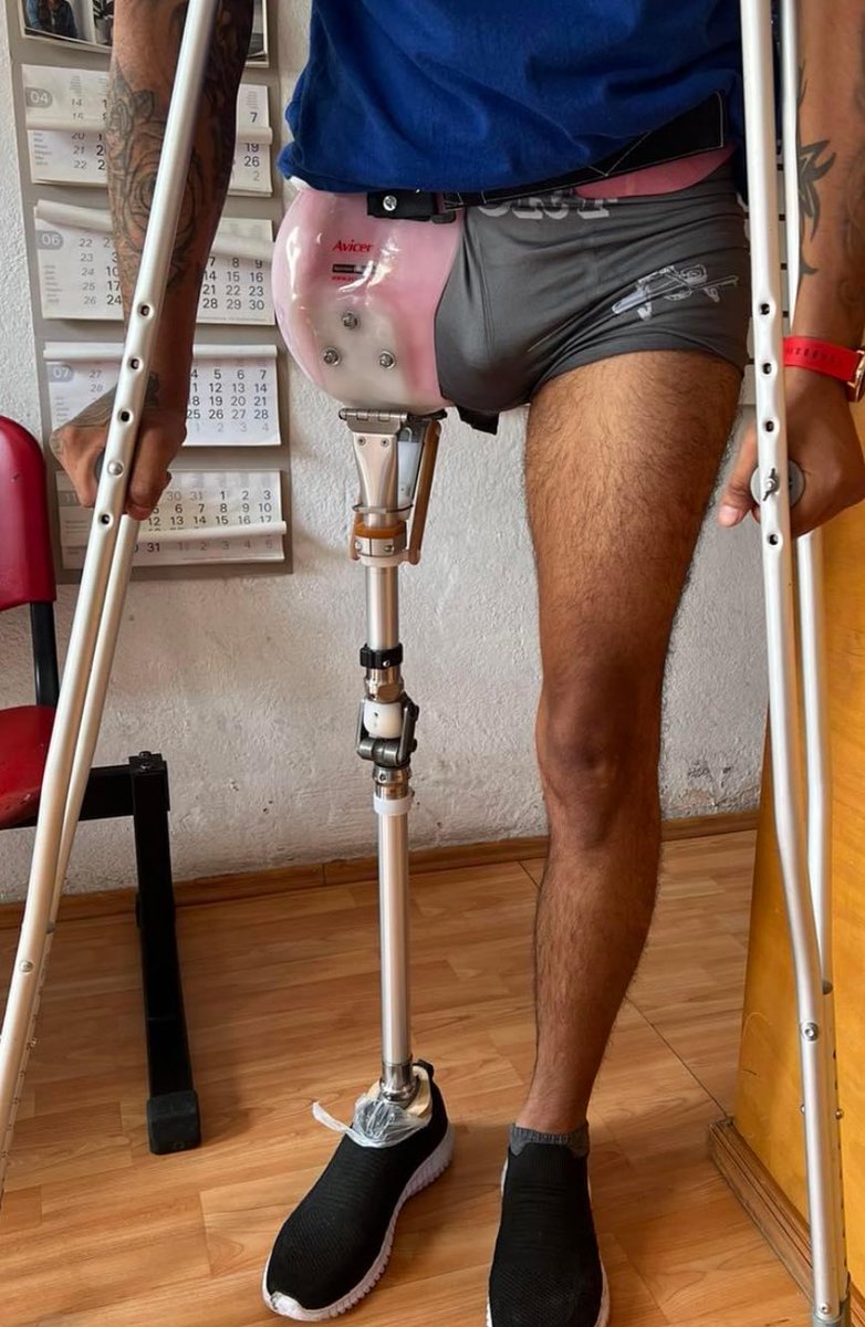 AVICER_'s tweet photo. #protesis para desarticulado de cadera, fabricada a medida con rodilla mecánica policéntrica, pie dinámico y canastilla de polietileno HD #avicer #ortopedia https://t.co/NOGKNnZ29d