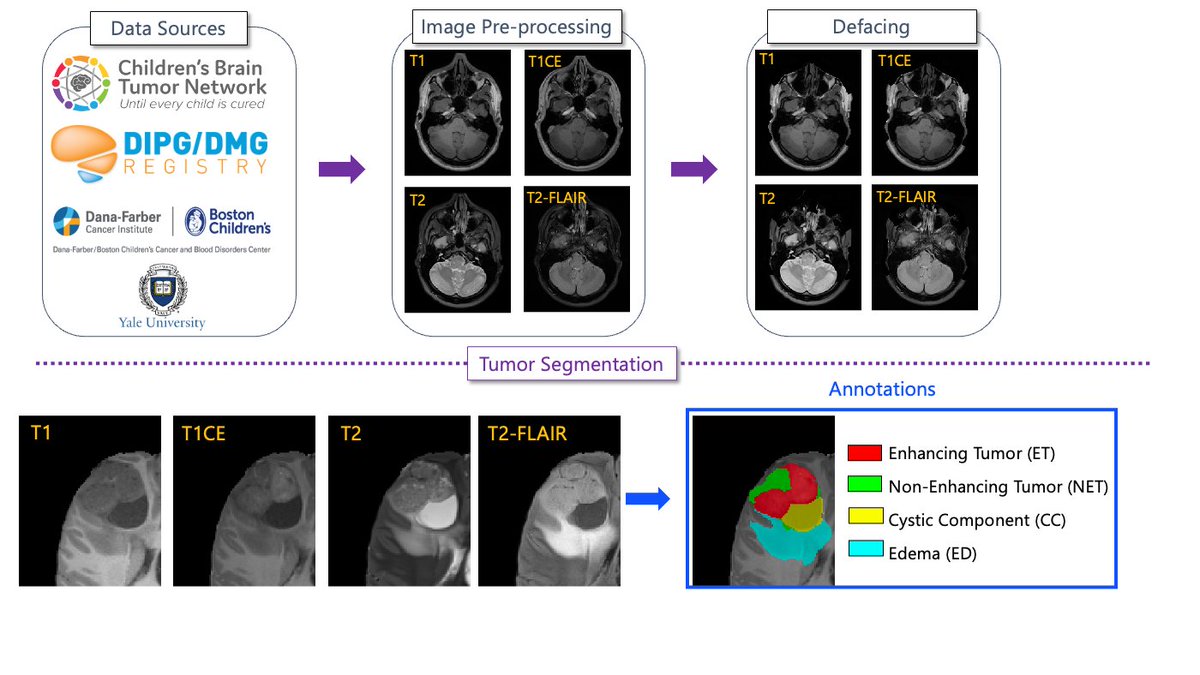 The "MR imaging of pediatric subjects with high-grade gliomas (DFCI-BCH-BWH-PEDs-HGG)" has been published on TCIA at doi.org/10.7937/v8h6-b…. This data was part of the ASNR-MICCAI BraTS Pediatrics Tumor Challenge which you can learn more about at synapse.org/Synapse:syn537…