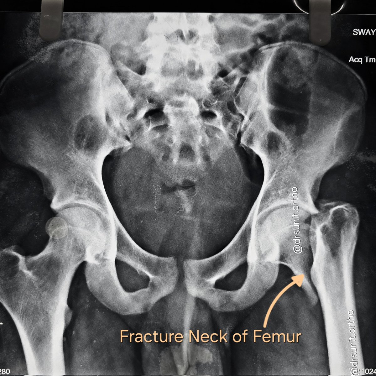 sunitpani's tweet photo. A case of High pauwels angle Neck of femur fracture in a young adult.
#ortho #MedTwitter #fracture  #femur https://t.co/xMbMcj823S