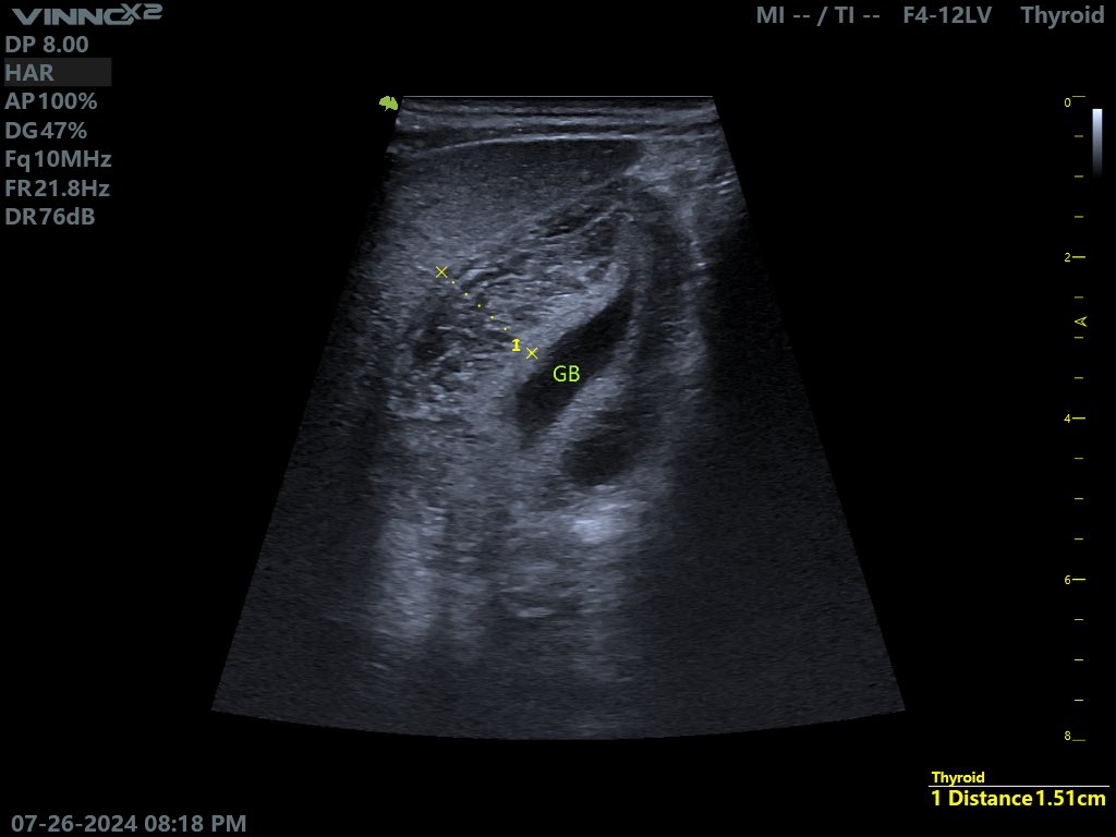 EchoTech_4's tweet photo. 9 years female presented with severe recurrent vomiting and jaundice.

Your opinion?

#Echo_Tech https://t.co/fVxBomiY09