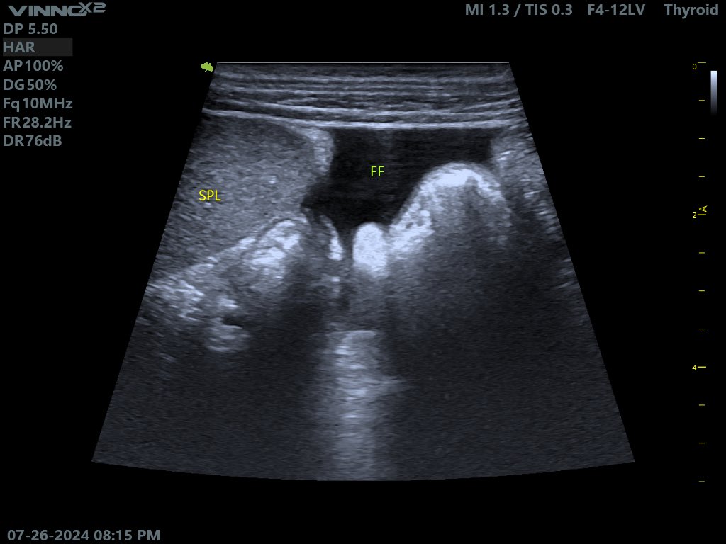 EchoTech_4's tweet photo. 9 years female presented with severe recurrent vomiting and jaundice.

Your opinion?

#Echo_Tech https://t.co/fVxBomiY09